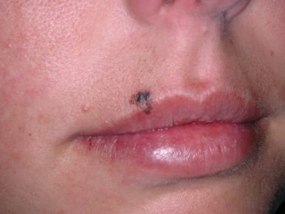 ISIC_0024207_melanoma