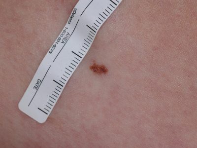 ISIC_0024253_melanoma