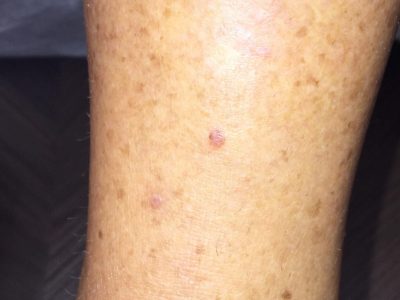 ISIC_3000292_melanoma