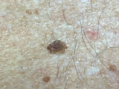ISIC_6241688_melanoma